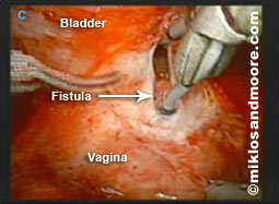 Bladder Fistula.jpg