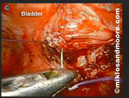 Fistula Repair picture 4