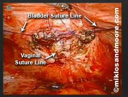 Fistula Repair picture 5