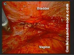 Picture 6—shows  a bladder full of water testing  the integrity of our surgical repair.  We tested the tightness of the repair only after doing a two layer closure on the bladder.   