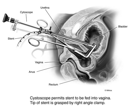 Fistula Repair Photo 1