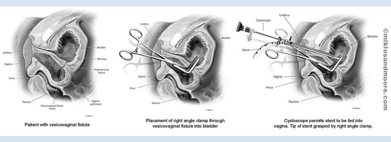 Operation Diagram for a Vesicovaginal Fistula - Image 1