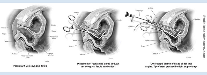 vesicocolic fistula