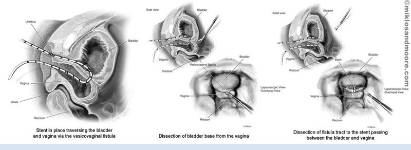 Operation Diagram for a Vesicovaginal Fistula - Image 2