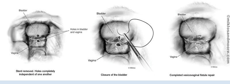 Operation Diagram for a Vesicovaginal Fistula - Image 3